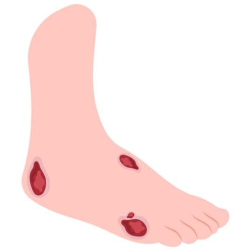 Example of a leg ulcer in cartoon form